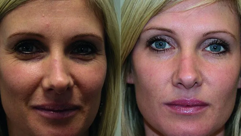 Botox
