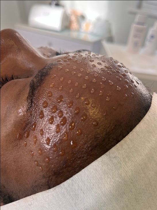 Mesotherapy